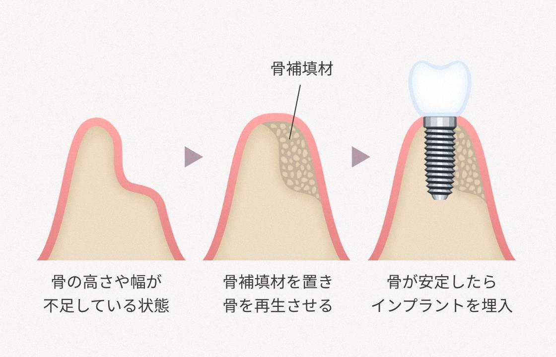 高度な治療（GBR法）